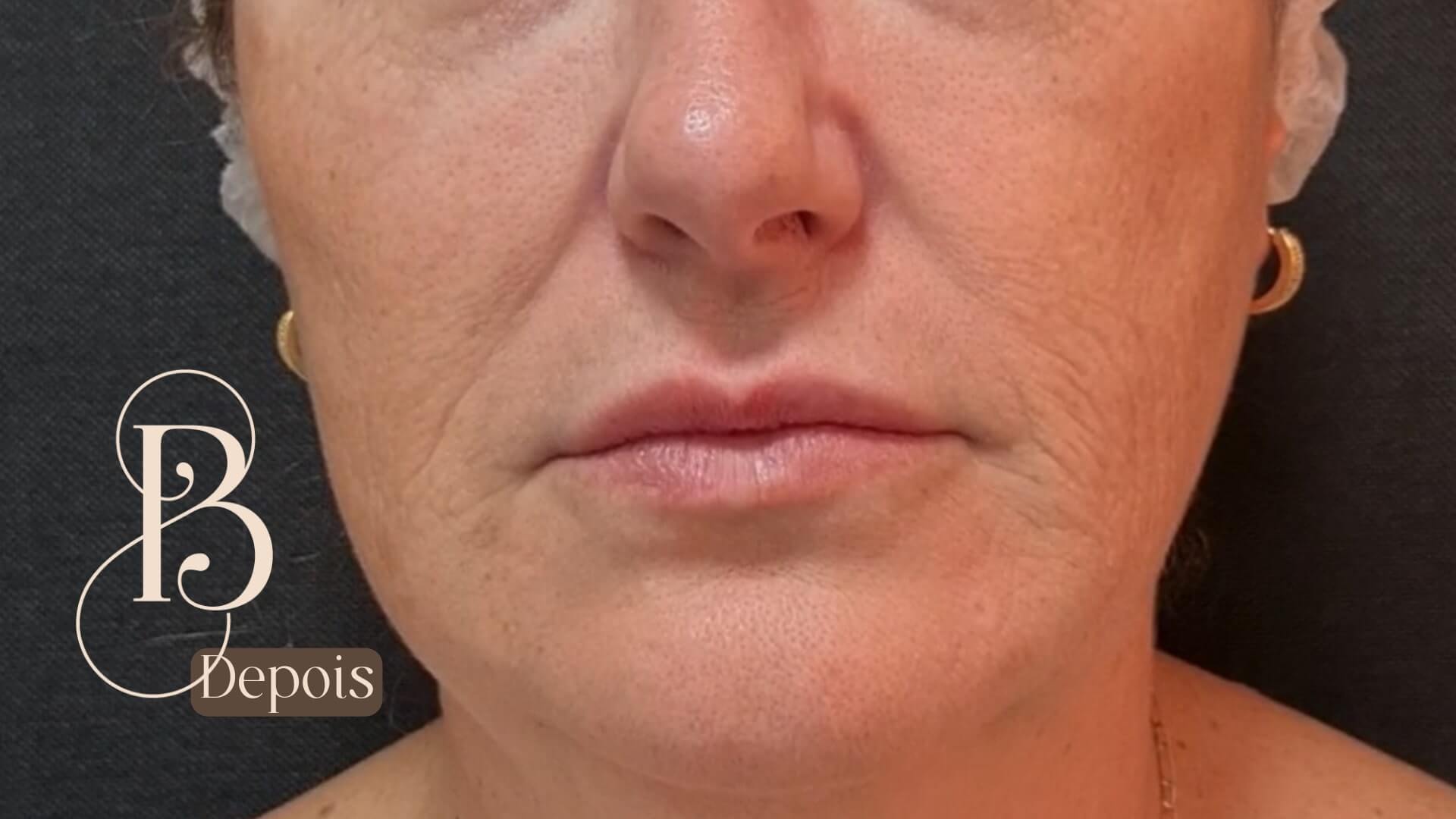 1 SESSÃO DE LIFTING FACIAL DEPOIS