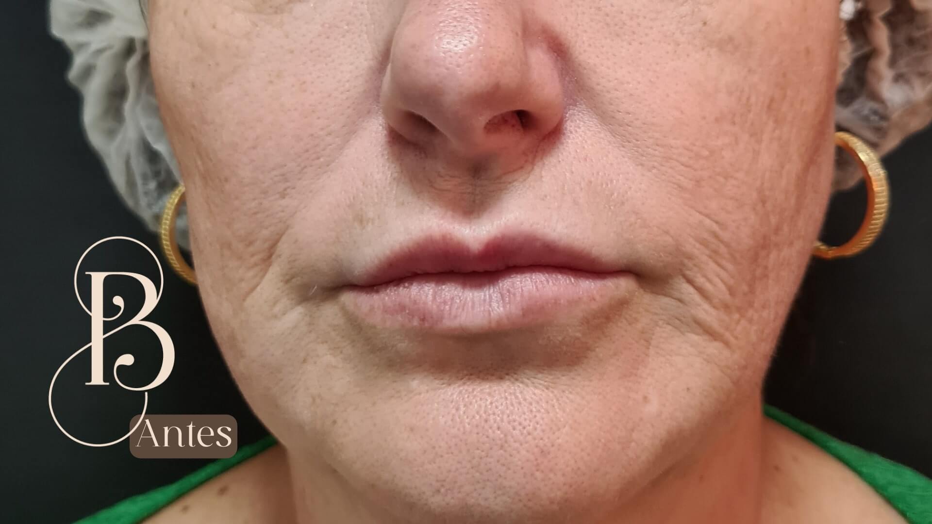 1 SESSÃO DE LIFTING FACIAL